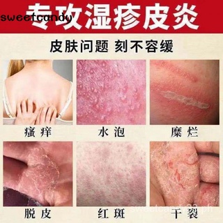 《SW》Sweat Herpes Hand Long Water Bubble Itching Feet Long Water Bubble Itching Vesicular Jade Hand Gas Fungus Infection Crack Kang Anti-Itch Ointment