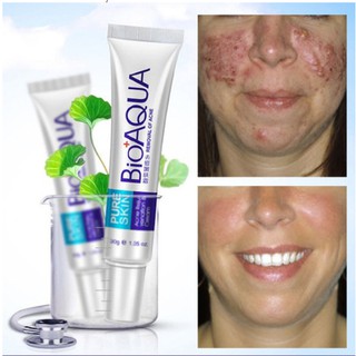 Bioaqua Acne Removal Scar Marks Cream Whitening Cream