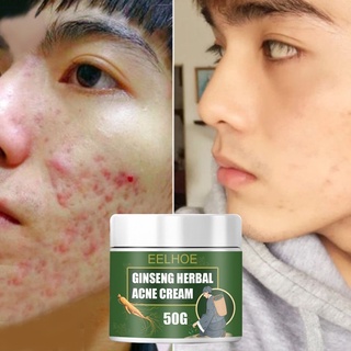 ginseng herbal acne cream pimple remover acne marks remover skin care products anti Acne Treatment