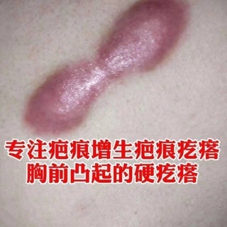 【Scar Buster】Traditional Chinese Medicine Scar Removal Ointment Hyperplastic Scar Pimple Concave-Con