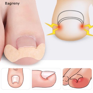 Bagreny 20Pcs Toenail Corrector Ingrown Toe Foot Nail Correction Patch Nail Sticker PH