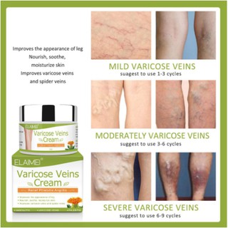 New & Improved Elaimei's Varicose Veins Remover - Cream for vasculitis, varicose veins, phlebitis (5)