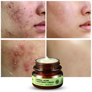 Herbal Anti Acne Cream Treatment Face Cream Scar Remover Gel Cream Pimple Removal Skin Care (3)
