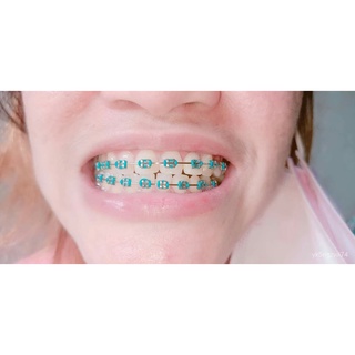 （Hot Sale）READY TO WEAR FASHION BRACES NORMAL DESIGN UPPER OR LOWER VcCx