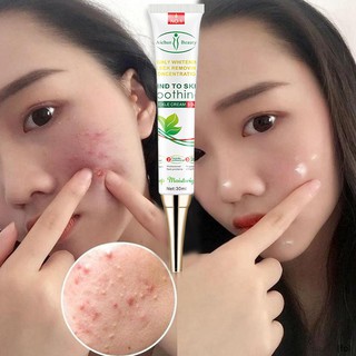 Acne and pimple remover Anti-freckle remove cream whtiening freckle cream to remove marks acne cream