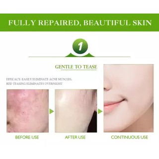 Skin Care Acne Cream Ointment Scar Treatment Face Serum Anti-Acne Facial Essence Pimple Remover (5)