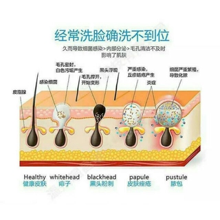 Facial Skin Care Acne Blackhead Remover Pore Clean Machine (4)