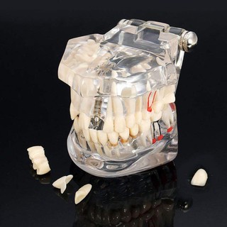 Removable Medical Pathological Extrusion Missing Dental Teaching Teeth Model for dentists and school