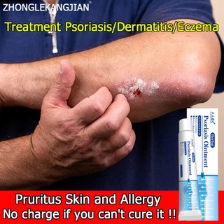 Psoriasis cream Ointment Treatment Dermatitis Eczema Rashes bactericidal Pruritus Skin and Allergy