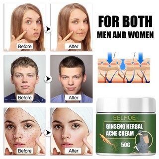 Acne treatment antibacterial ointment skin care beauty cream ginseng herbal pimple remover anti acne (3)