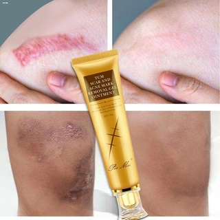 Eyes✣☋Scar Removal Cream scne scar remover peklat remover stretch mark remover legs Treatment Contro