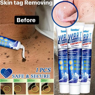 Wart Removal tag remover Repair Cream Foot Care Cleans the skin and removes plantar ointment 20g PH
