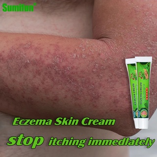 【 Sumifun】Eczema Skin Cream Skin Allergies Skin Cream Herbal Medicine Antifungal Ointment（20g）
