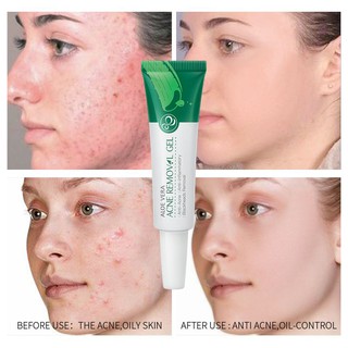 LAIKOU Aloe Vera Acne Removal Gel Moisturizing Oil Control Anti-Inflammatory Remove Acne and Pimples Improve Dry Rough Skin