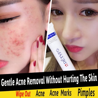 Acne Gel Soothing repair Acne Aloe vera gel Acne cream herbal pimple remover acne marks 20ml (1)