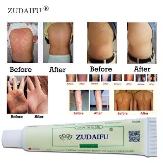 ZUDAIFU Natural Chinese Herbal Medicine Cream Eczema Dermatitis Psoriasis Vitiligo Antibacterial Skin Disease Treatment Skin Care Cream