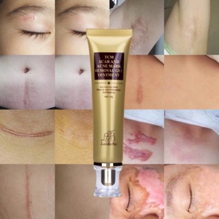 Lanbena acne scar removal cream skin repair face cream acne