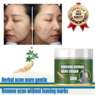 Acne treatment antibacterial ointment skin care beauty cream ginseng herbal pimple remover anti acne (1)