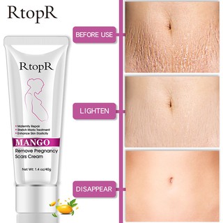 Rtopr Mango Remove Pregnancy Scars Acne Cream Stretch Marks Treatment Mater 40ml (1)
