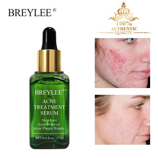BREYLEE Acne Treatment Serum Anti Acne Scar Removal Cream Whitening Repair Pimple Skin Care 17ml