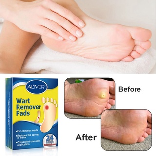 Aliver Corn Removal Patch Toe Callus Corn Remover Pads Wart Treatment Patch For Foot (5)