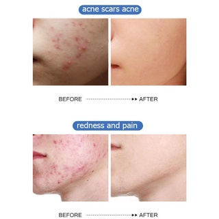 Han Yu Whitening Moisturizing Cream Acne Essence 30g Face Essence Cream Scar Acne Treatment Serum (5)