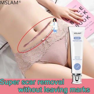 MSLAM Scar Removal Cream Scar Remover Marks cream Scarring Acne Spots Stretch Burn Stretch Mark