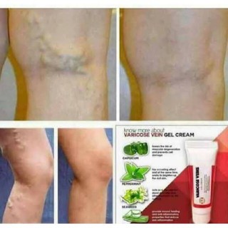 ⛔️ Bare Body ⛔️ Varicose Veins Gel Cream 10ml Hot Products Wholesale Varicose veins remover ugat
