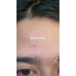 G21 Pimple Patch (Hydrocolloid Patch) (3)