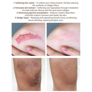 VG Scar Remover Acne Scar remover Cream Scars Repair Stretch Marks Pregnancy Scars Scalded (5)