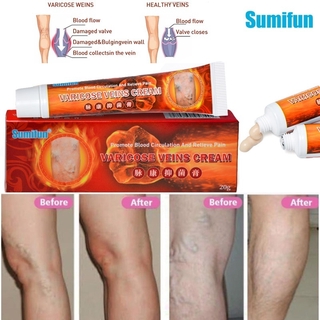 Sumifun 20g Varicose Veins Treatment Cream Effective Cure Vasculitis Phlebitis Spider Veins Pain Varicosity Angiitis Ointment