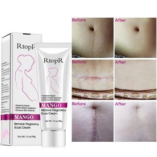 RtopR Mango Remove Pregnancy Scars Acne Cream Stretch Marks Maternity Treatment Anti-Aging Repair Sk
