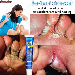 Sumifun athlete's foot cream, remove the athlete's foot fungus to inhibit the growth of bacteria app