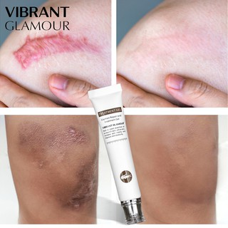 VG scar removal Acne Cream Scar Cream Scars Repair Stretch Marks Pregnancy Scars Scalded Surgery QJS