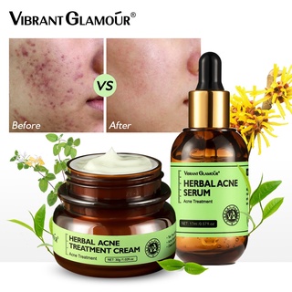 Herbal acne cream acne acne pits pits acne scars acne men and women desalination repair cream