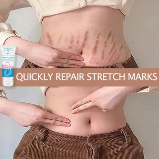 Stretch Mark Remover Stretch Mark Lotion Peklat Remover For Legs Remove Postpartum Stretch Marks