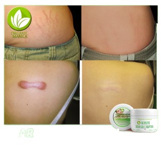 【good-looking】₪☇Ultimate Scar Care Solution, Stretch Mark, Kelloid, All types of Scar Remover