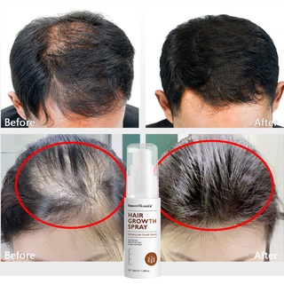 VIBRANT GLAMOUR Hair Growth Essence Spray Liquid Preventing Baldness Nourish Hair Anti Hair Loss30ml