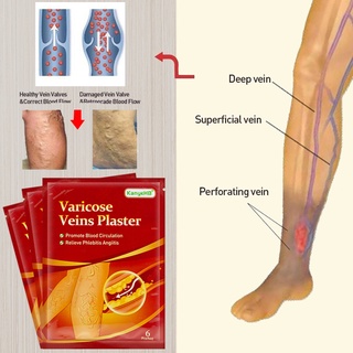 6pcs/12pcs/24pcs/30pcs Varicose vein patch pain relief pain relief knee patch muscle