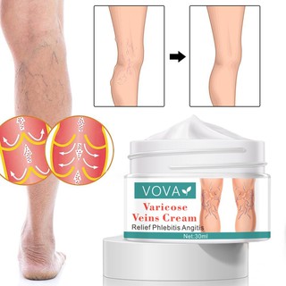 Varicose Vein Remover Varicose Cream Varicosity Angiitis Remedy Ointment Relief Veins Pain Effective