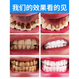 ◎◆☑[Removing yellow teeth and black teeth artifact] Dental plaque cleaning to remove yellow teeth an