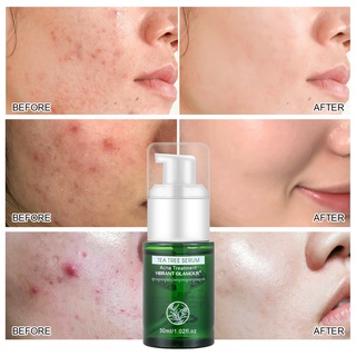 VIBRANT GLAMOUR Herbal Acne Treatment Set Tea Tree Oil Acne Removal Face Serum Gel Cream Anti-Acne Clear Pimples Firming Pores For Oily, Acne Prone Skin Acne Scar Repair Facial Moisturizer 3PCS (3)