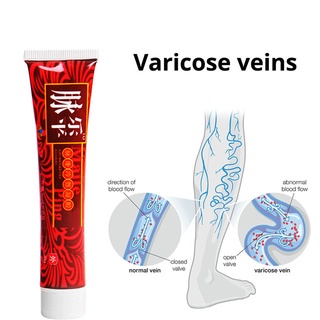 10PCS Varicose Veins Treatment Cream Effective cure Vasculitis Phlebitis Spider Veins Pain
