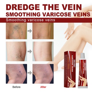 Varicose Veins Treatment Cream Ointment Vasculitis Phlebitis Spider Veins Pain Varicosity Effective (1)