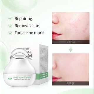 【spot goods】✠In Stock Effective Anti-Acne Cream Acne Treatment Vacuum Acne Flakes Oil Control Shrink (1)