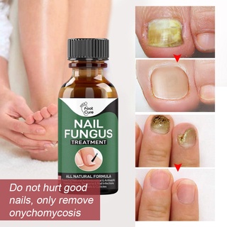 Nail Repair Essence Serum Fungal Nail Treatment Remove Onychomycosis Toe Hand Foot Skin Care