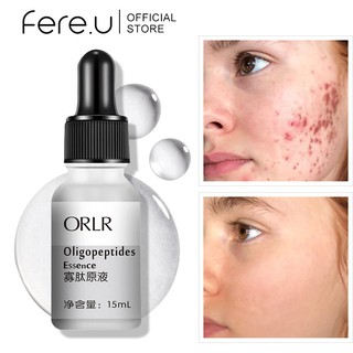 Fere.U Acne Treatment Serum Whitening Moisturizing Repair Pimple Shrink Pores tightening Skin Face Solution 15ML