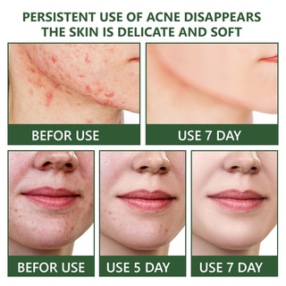 Old Acne Scar Remover Serum Acne Treatment Cream Remover Acne Surgical Stretch Marks Repair Cream (5)