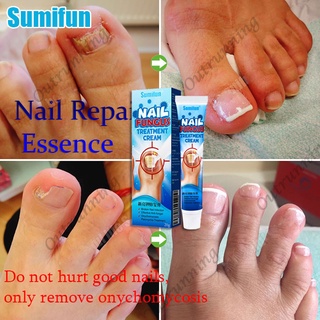 [Original]Sumifun Nail Fungal Treatment Anti Fungus Remove Onychomycosis Toe Nail Treatments 20g
